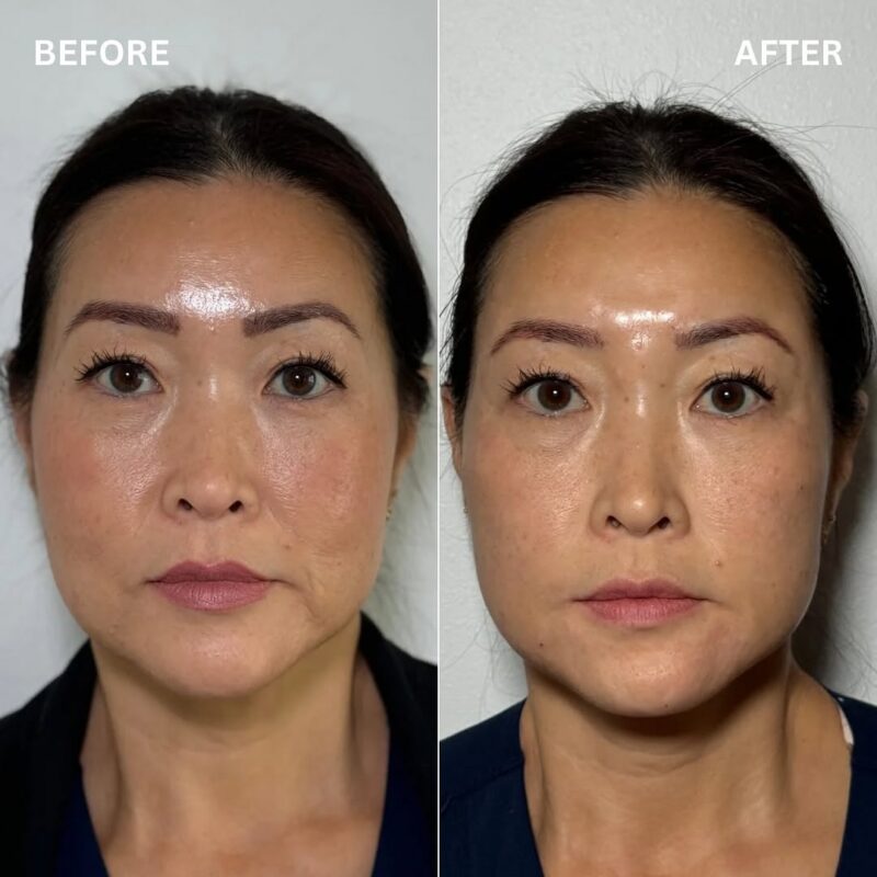 Skin Rejuvenation