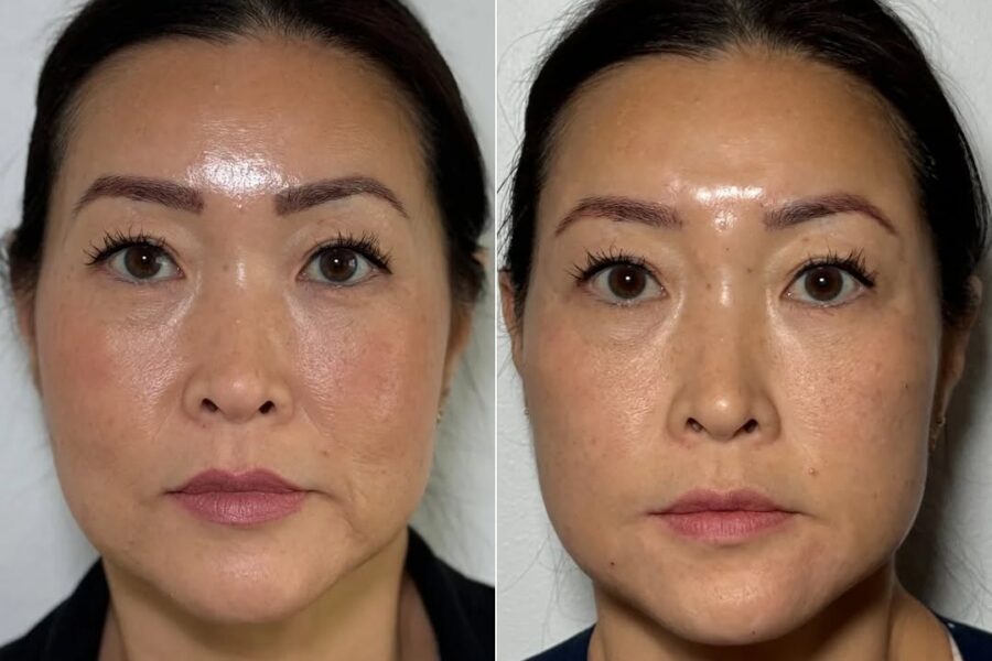 Skin Rejuvenation