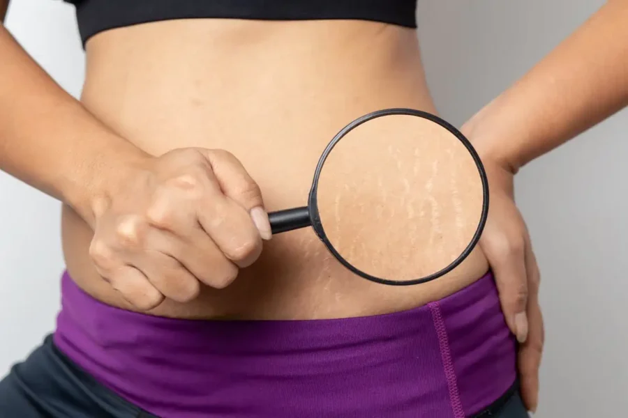 Stretch Marks-Epiphany Medspa Wellness-FULLERTON