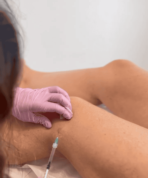 Sclerotherapy treatment