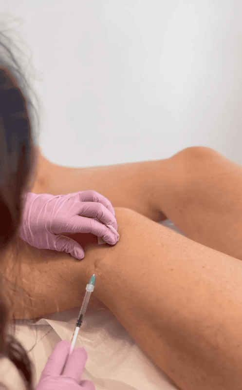 Sclerotherapy treatment