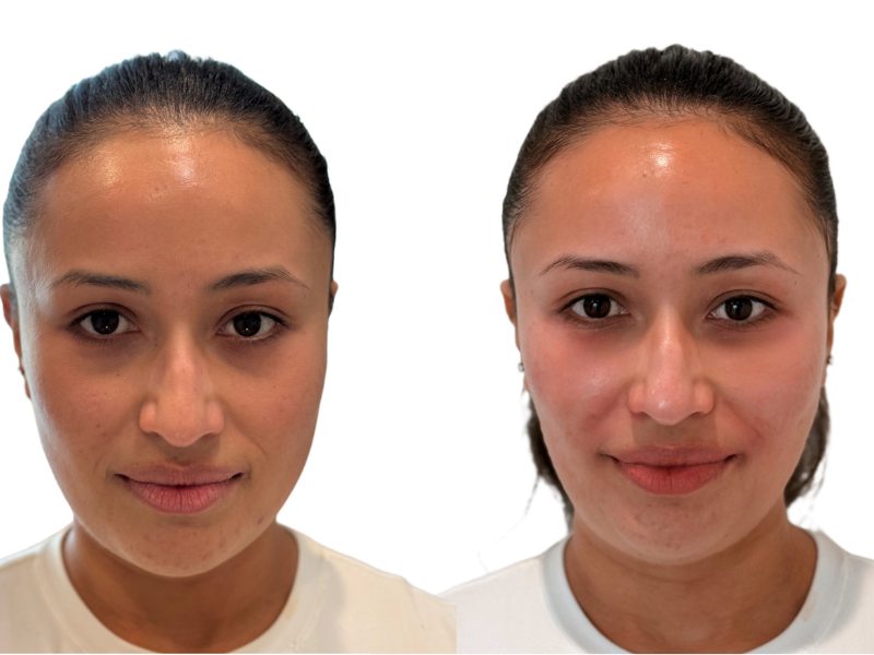 How PRF EZ Gel Works