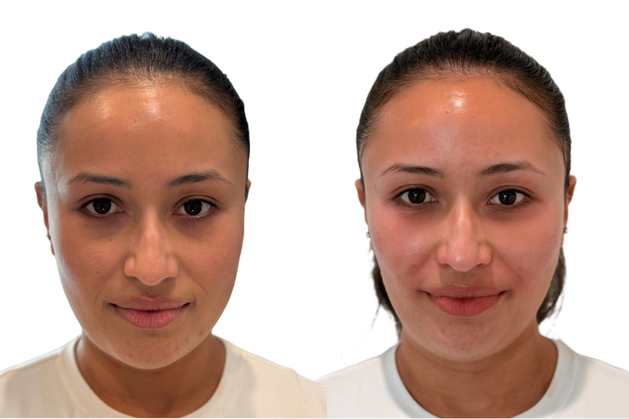 How PRF EZ Gel Works