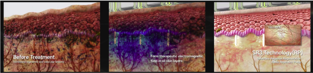 Sylfirm X RF Microneedling treatment